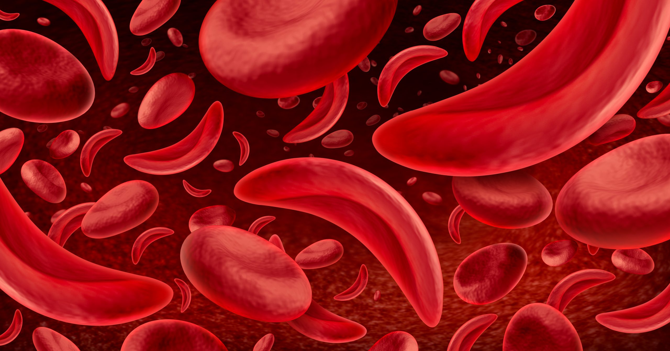 New Imara Framework Aims to Unify Sickle Cell Care in Africa