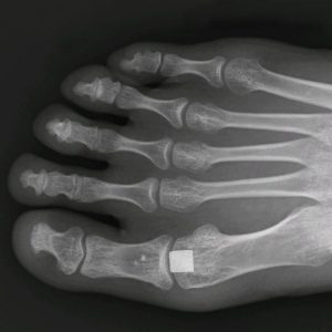 Cartiva Implant